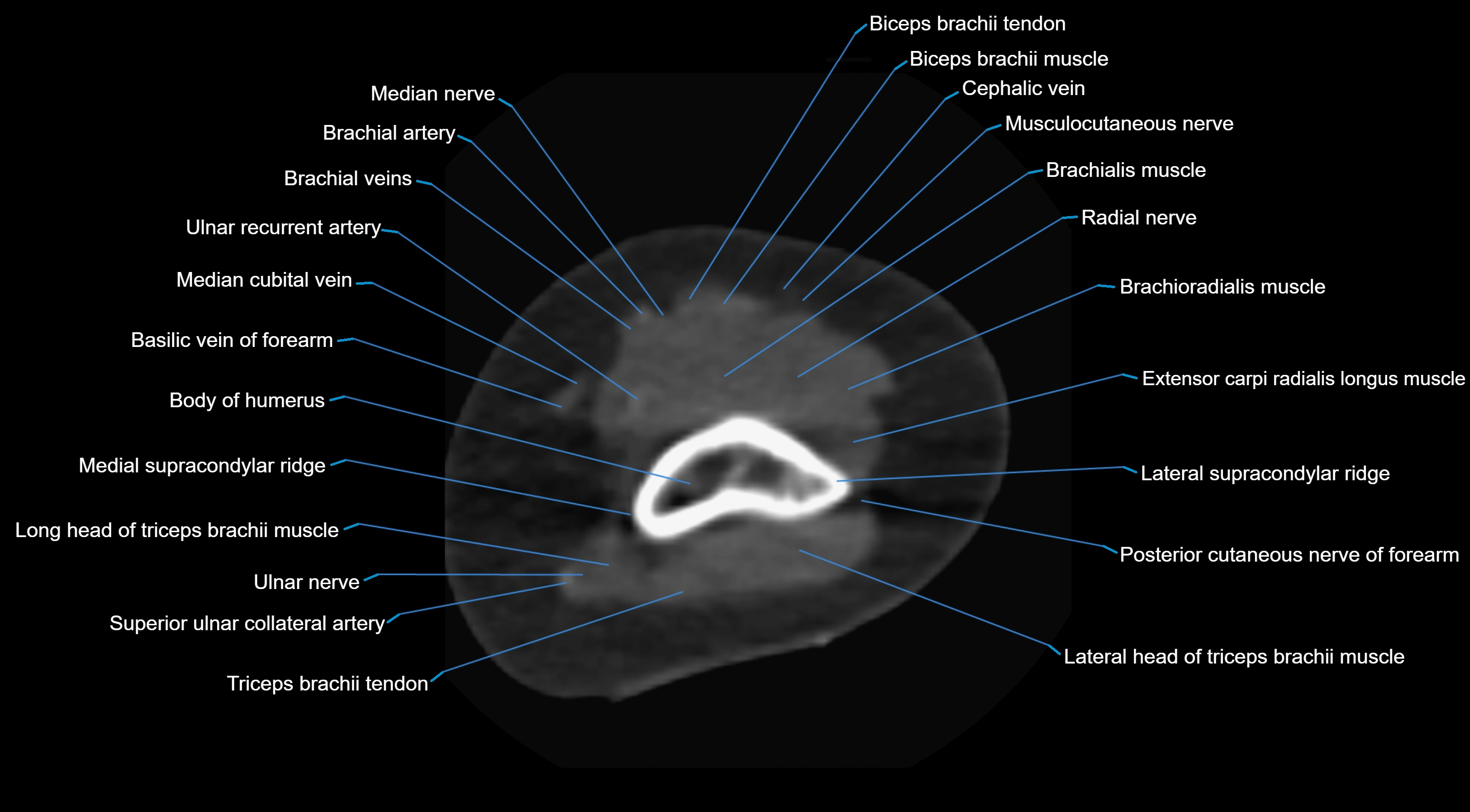 CT elbow axial  cross sectional anatomy labelled  radiology image -00008.webp